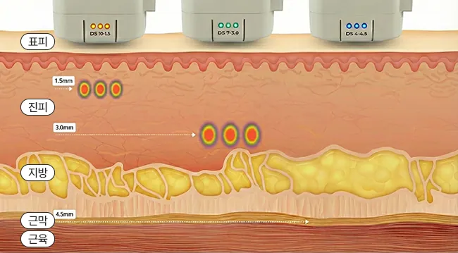 Ultherapy Prime