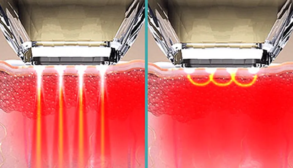 Potenza / Intracel — How it works
