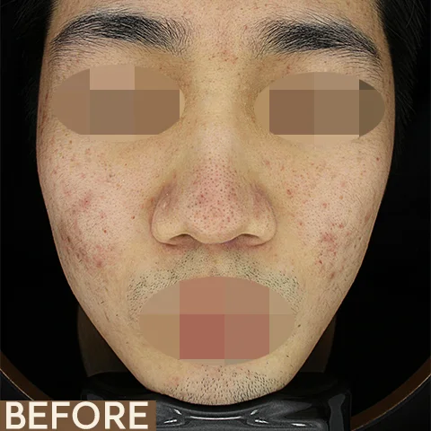 A patient's face before and after fifteen Excel V+ sessions for pigment. Eyes and mouth are obscured.