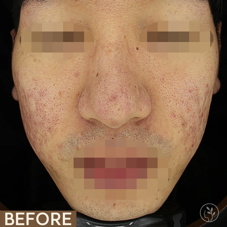 A patient's face before and after five Fraxel sessions for pores and scarring. Eyes and mouth are obscured.