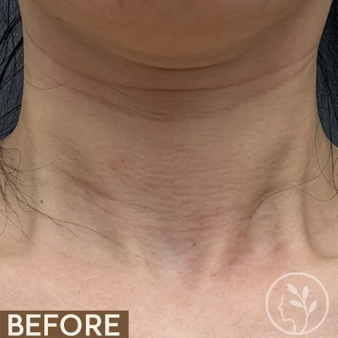 A patient's neck before and after filler for horizontal lines.