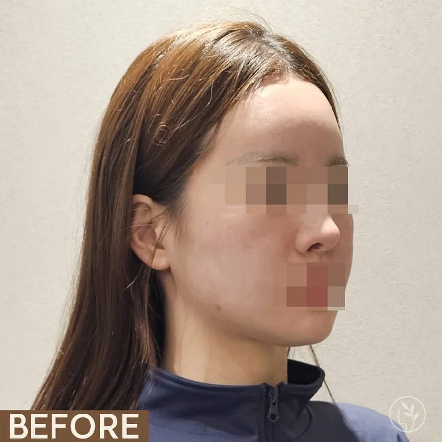 A patient's face at three quarters before and after ONDA. Eyes and mouth are obscured.