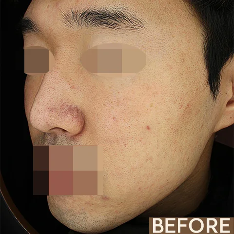 A patient's face before and after Vbeam Perfecta combined with Excel V+. Eyes and mouth are obscured.