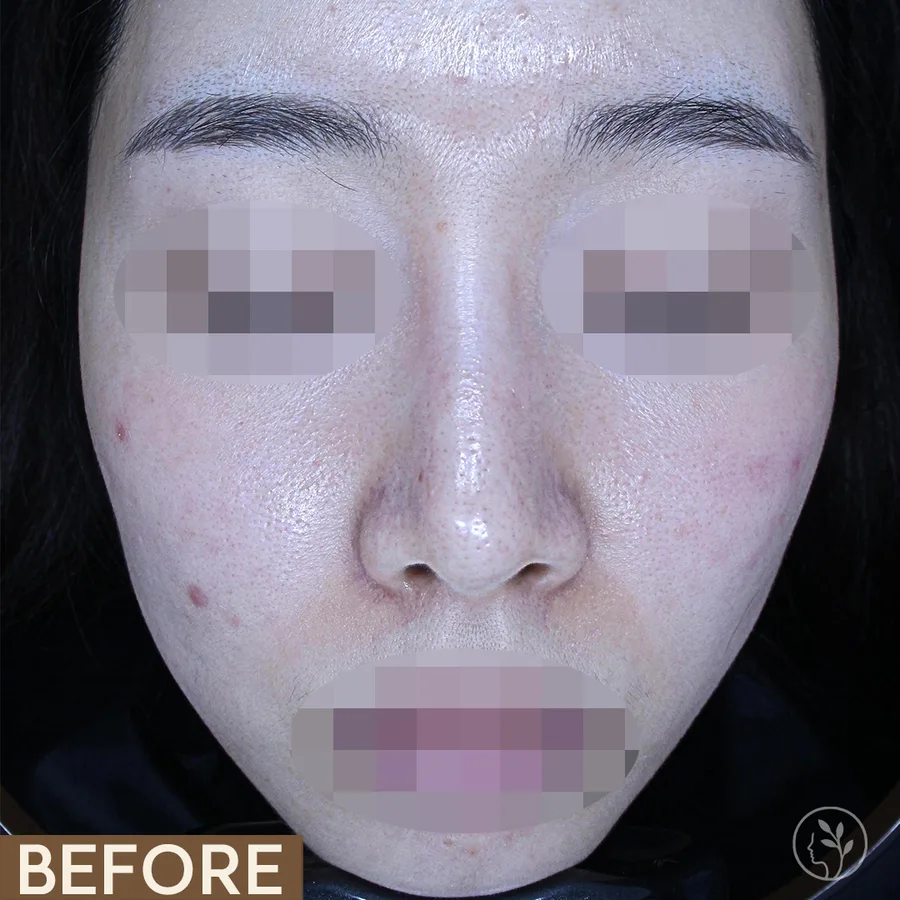 A patient's face before and after fifteen Vbeam Perfecta sessions for redness. Eyes and mouth are obscured.