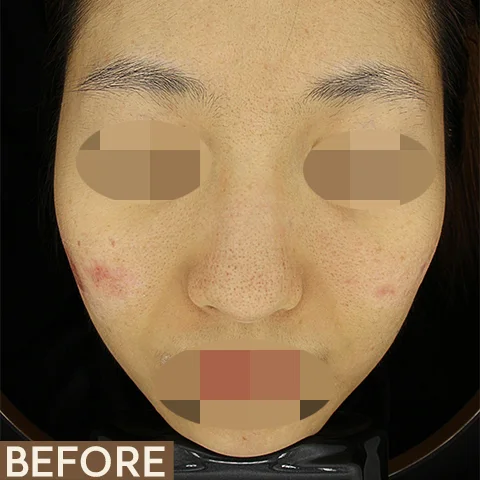 A patient's face before and after six Vbeam Perfecta sessions for redness. Eyes and mouth are obscured.