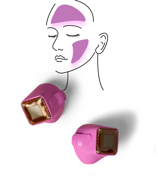 Face treatment zones for Thermage FLX — forehead and cheek marked — with the 4.0 cm² Total tip, illustration by Solta Medical